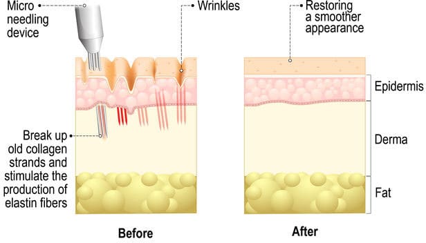 Microneedling-Collagen-Induction-Therapy-Beaverton-Oregon