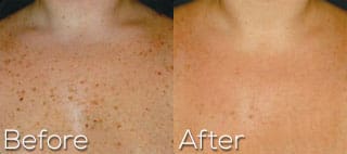 Photofacial-AFT-Chest-Before-After-Beaverton-OR