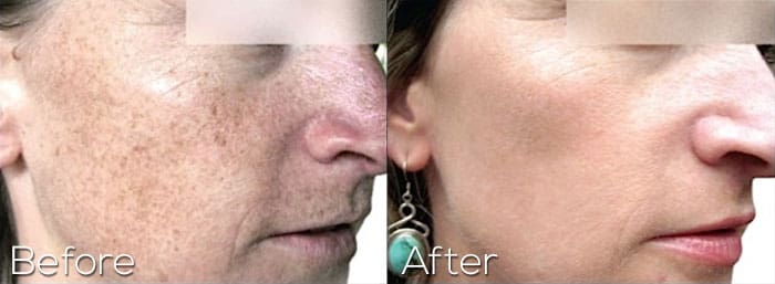 Photofacial-AFT-Face-before-And-After-Portland-Oregon