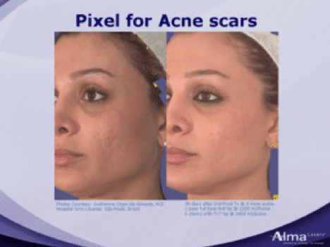 Pixel for Acne Scars before and after pictures